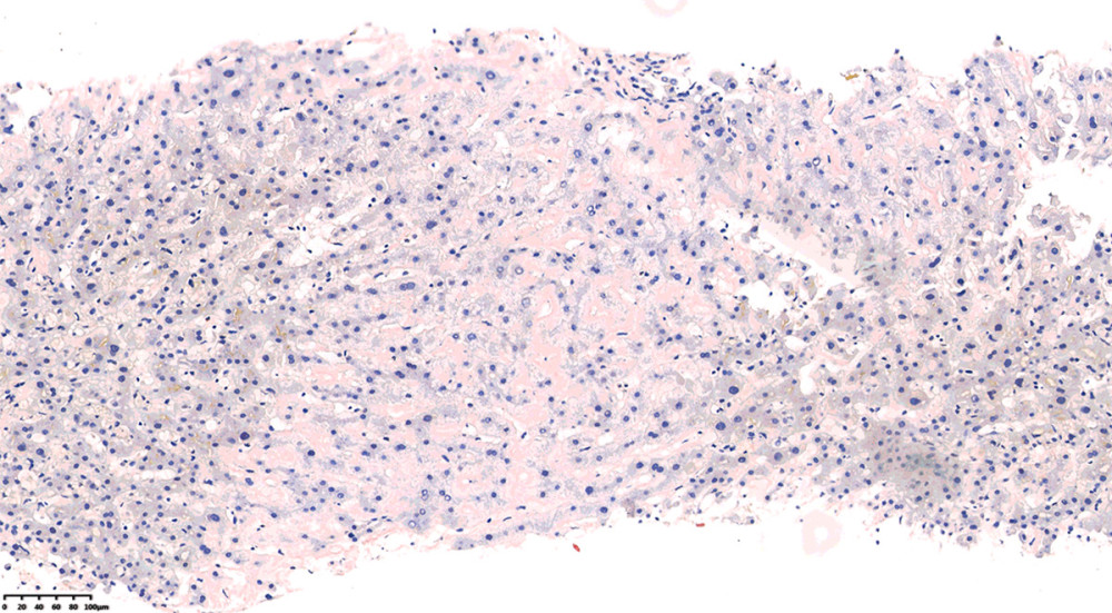 Congo red staining demonstrating findings characteristic of light chain amyloidosis.