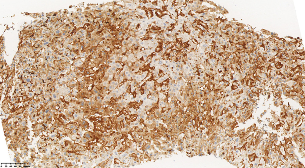 Positive immunostaining with antibodies against kappa light chains.