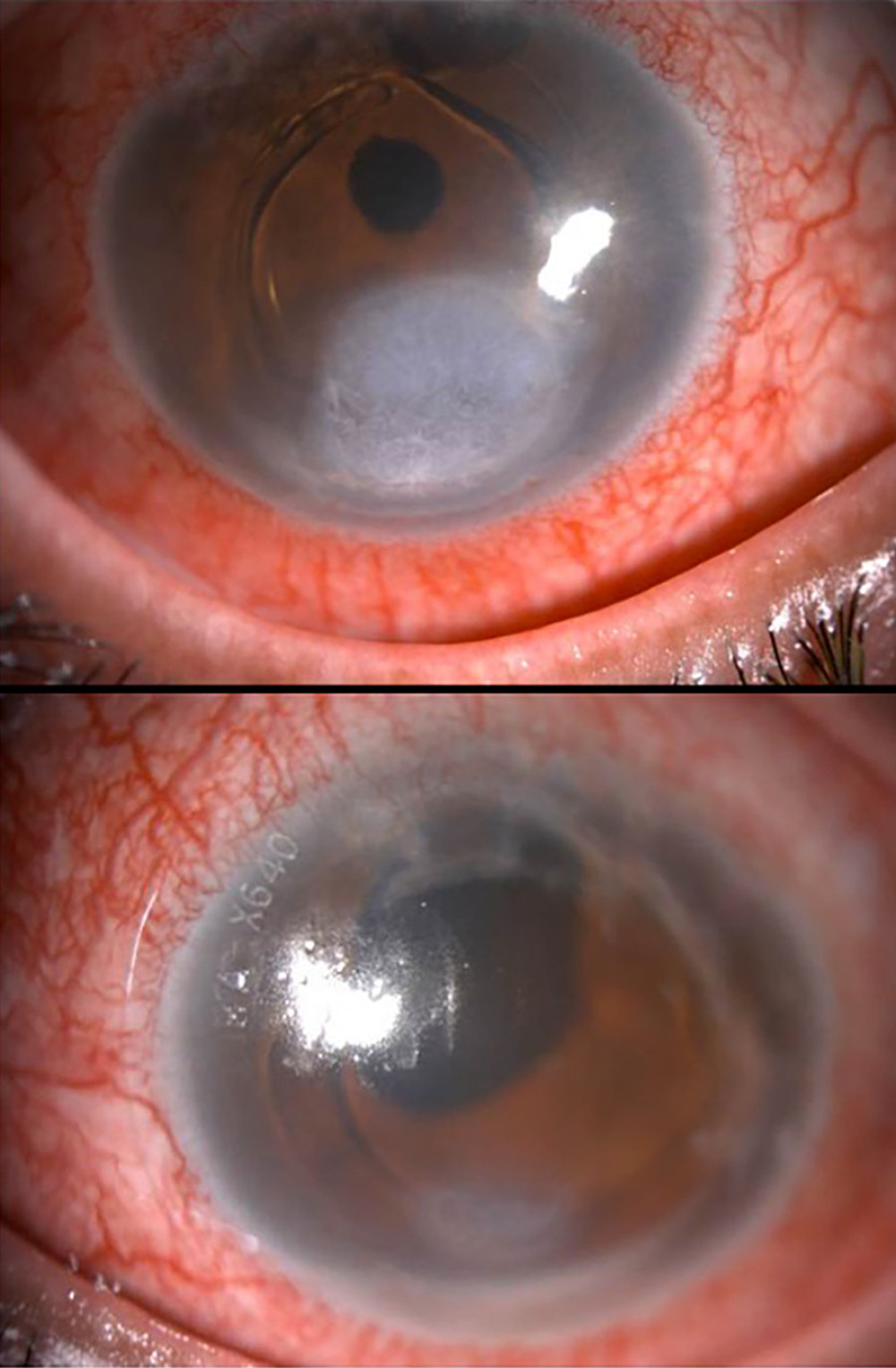 Corneal epithelial defect right eye: 4 mm vertical×4 mm horizontal with rolled edges and left eye: 2 mm vertical×1 mm horizontal.