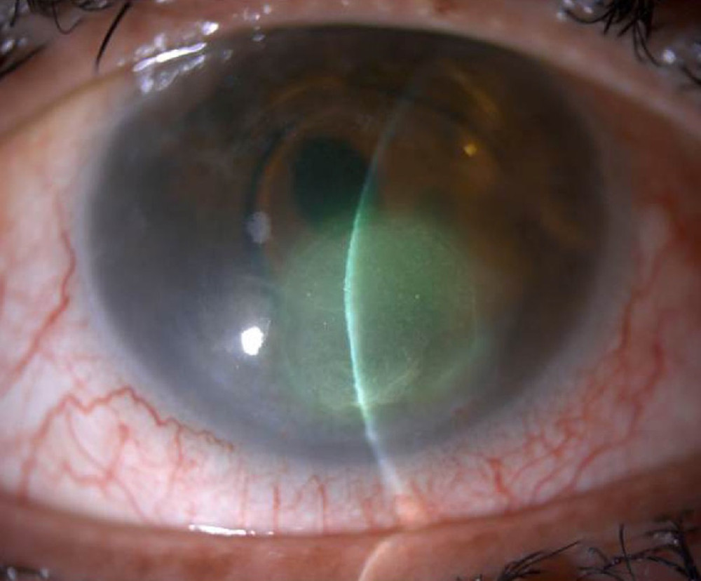 Improvement in the right eye with conservative management.