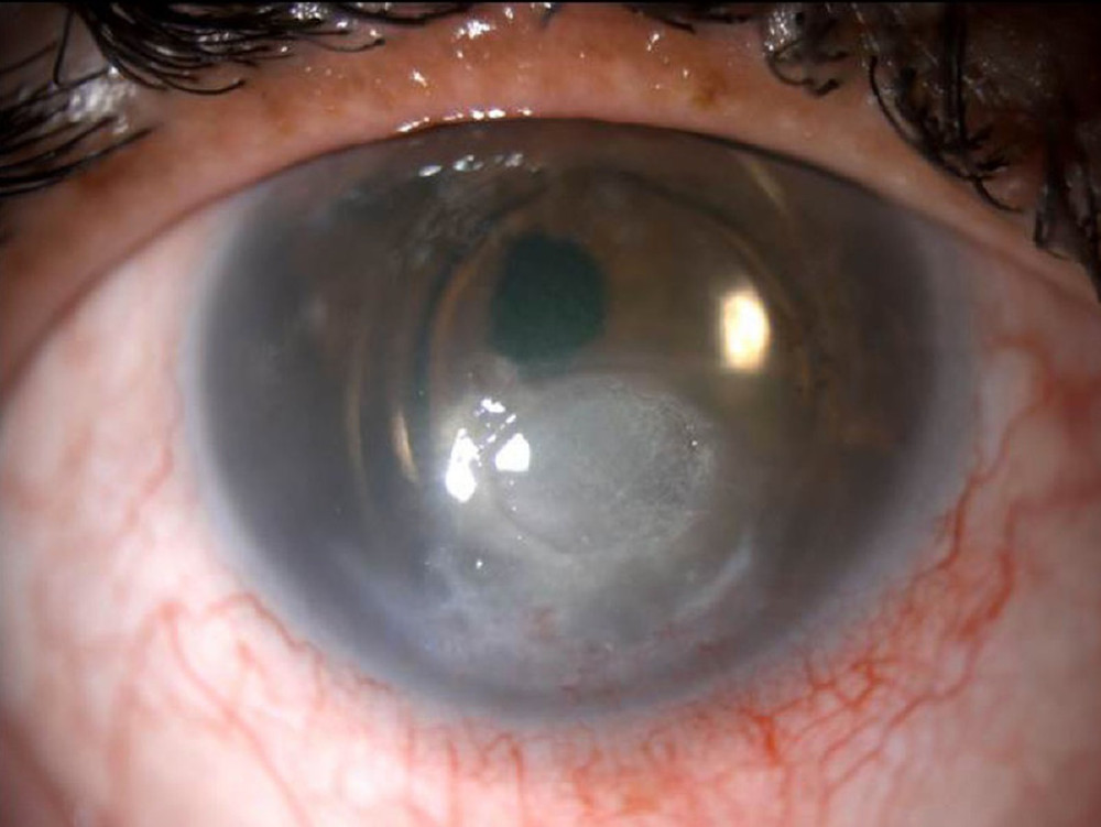 Progression of neurotrophic keratopathy.