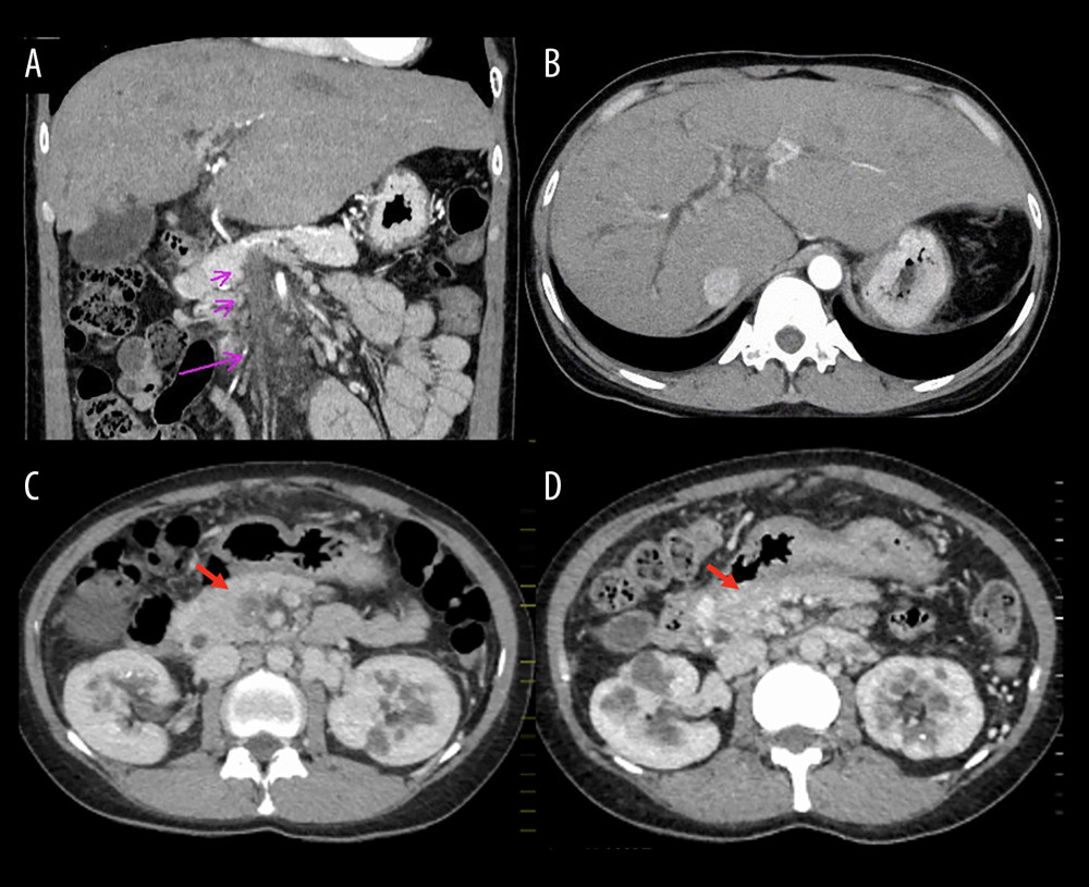 Abdominal computed tomography showing a superior mesenteric vein thrombus in the portal vein, with mesenteric panniculitis and numerous collateral blood vessels (A: coronal axis), and dilatation of the common bile duct (B: horizontal axis). A septic thrombophlebitis of the portal vein on admission (C: red arrow) disappeared after 9 months of anticoagulation (D: red arrow).