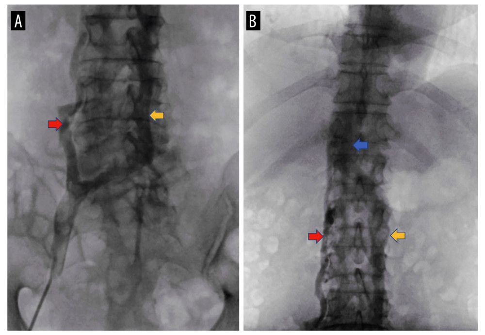 Venography of duplicate IVC. (A) Venography from right iliac vein presented duplicate IVC. (B) The left IVC gone right at the level of the 1st lumbar vertebral body and merged with the right IVC. The red arrow shows the right IVC, the yellow arrow shows the left IVC, the blue arrow shows the merge point of left and right IVC.
