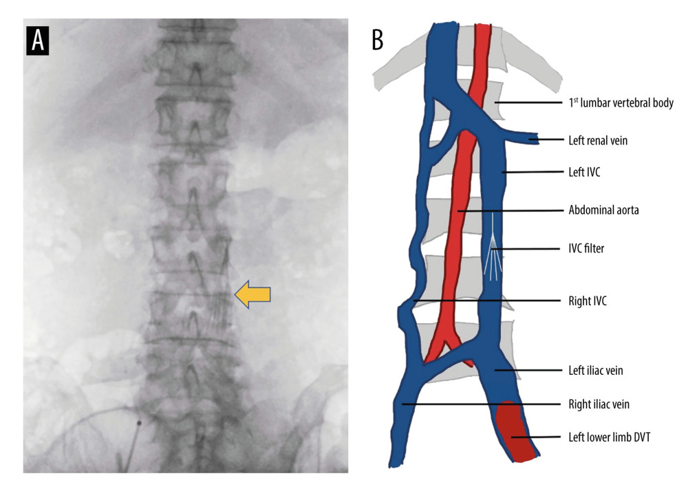 IVC filter placement strategy. (A) Left IVC filter placement position (the arrow shows the filter). (B) The pattern diagram of the IVC, abdominal aorta, and the filter.