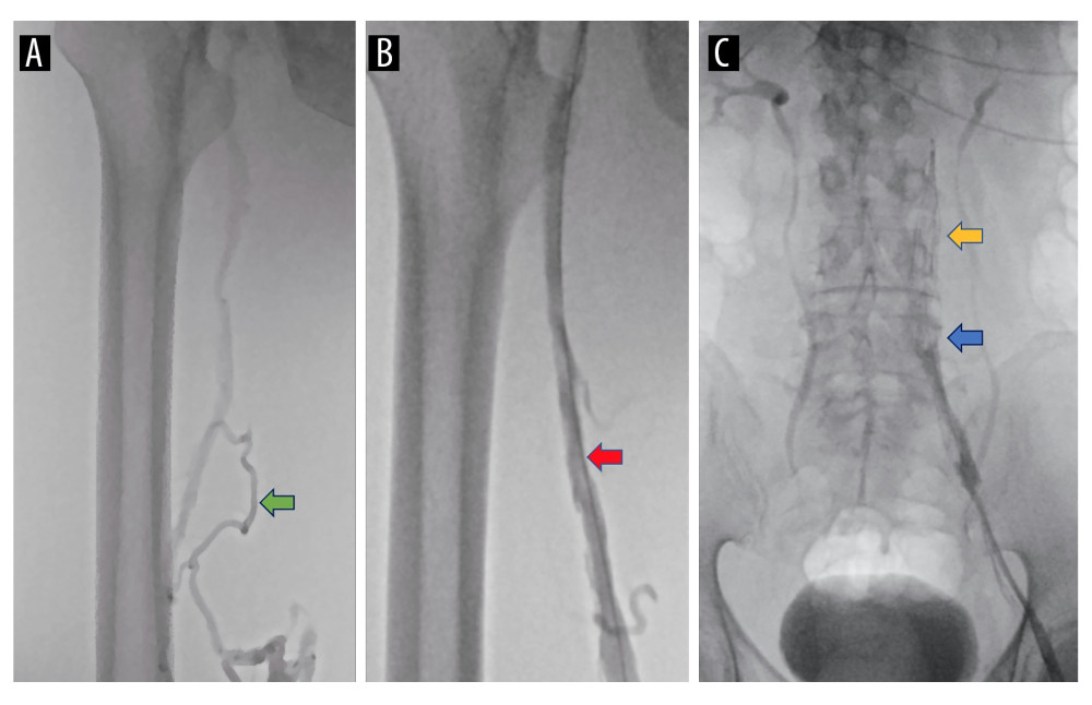 Comparison of the left lower-limb DVT before and after surgery. (A) Venography before intervention revealed extensive thrombosis in the left lower-limb deep vein. The contrast agent was unable to pass through, and many collateral veins were visualized. The green arrow shows the collateral veins. (B) Venography after intervention revealed the contrast agent passed smoothly through the left lower-limb deep vein, and the venous lumen was relatively wider. The red arrow shows the recanalized deep vein. (C) IVC venography after thrombolysis and aspiration treatment of DVT revealed some thrombus under the filter. The blood flow from the left iliac vein returned only to the left IVC, and no communicating branches were found between left and right IVCs. The yellow arrow shows the IVC filter and the blue arrow shows the thrombus under the filter.