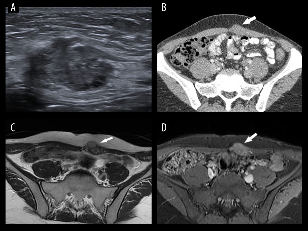 Ultrasound (A), axial contrast enhanced CT (B), Axial T2 MRI (C), and Axial T1 post contrast MRI (D) images demonstrate the small ovoid mass within the left abdominus rectus muscle (white arrows). CT, computed tomography; MRI, magnetic resonance imaging.