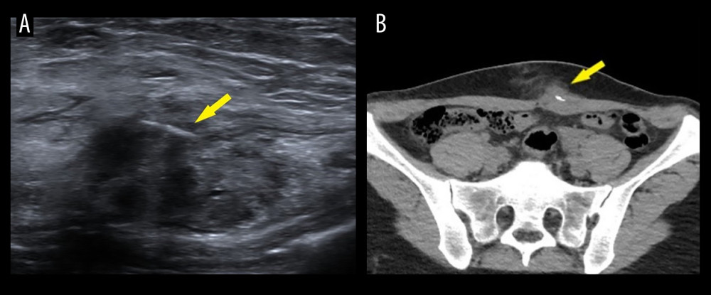 Ultrasound (A) and non-contrast procedural CT (B) images show Savi Scout in position within the upper 1/3 of the mass pre-surgery.