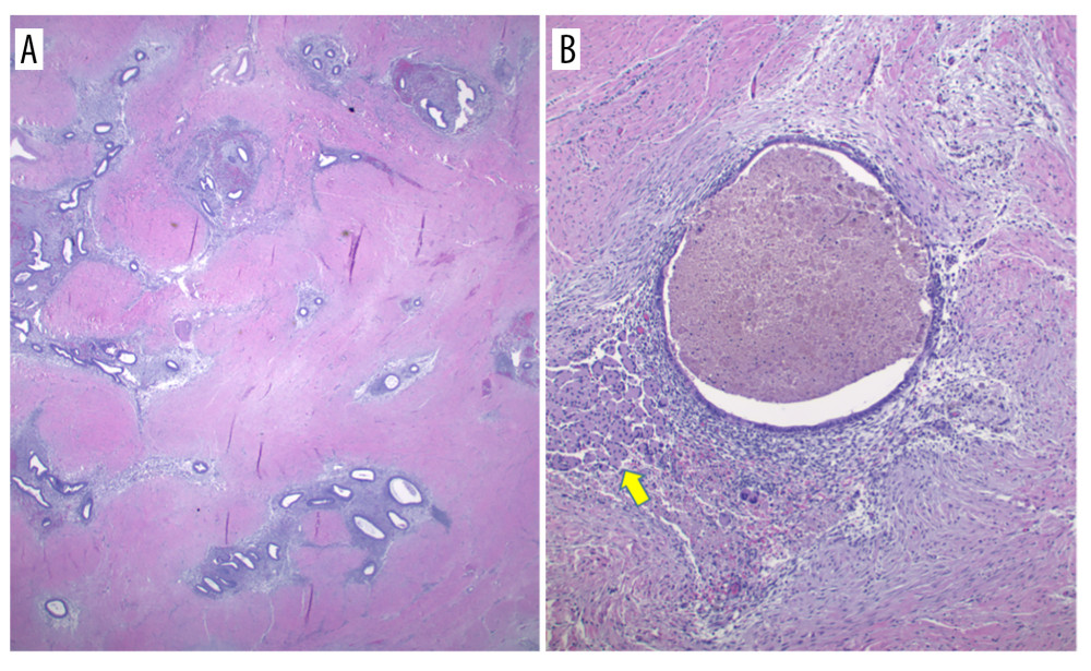 Hematoxylin and eosin (H&E)-stained sections (A) showing clusters of endometrial glands surrounded by endometrial stroma with scattered hemosiderin-laden macrophages, consistent with endometriosis (20×); dilated endometrial gland (B) with adjacent atrophic skeletal muscle (arrow) in fibrous stroma (100×).
