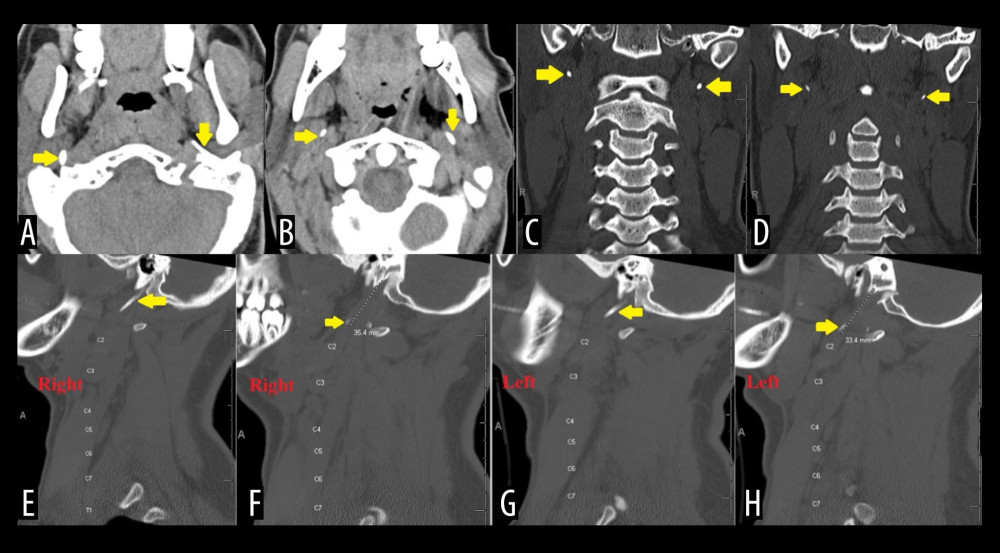 Initial axial (A, B), coronal (C, D), and sagittal (E–H) computed tomography scans showing bilateral elongation of the styloid processes (yellow arrows). The right styloid process measured 35.4 mm (F) and the left styloid process measured 33.4 mm (H) (yellow arrows in F and H point toward the terminal portion of each styloid process). Note the posterior location of the elongated styloid process relative to the parapharyngeal space (B).