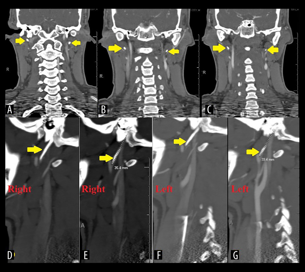 Coronal (A–C) and sagittal (D–G) computed tomography angiography of the neck showing bilaterally elongated styloid processes (yellow arrows) with no evidence of vascular injury. The styloid processes are measured in E and G. The elongated styloid processes run in close proximity to the carotid arteries as can be seen in D–G.
