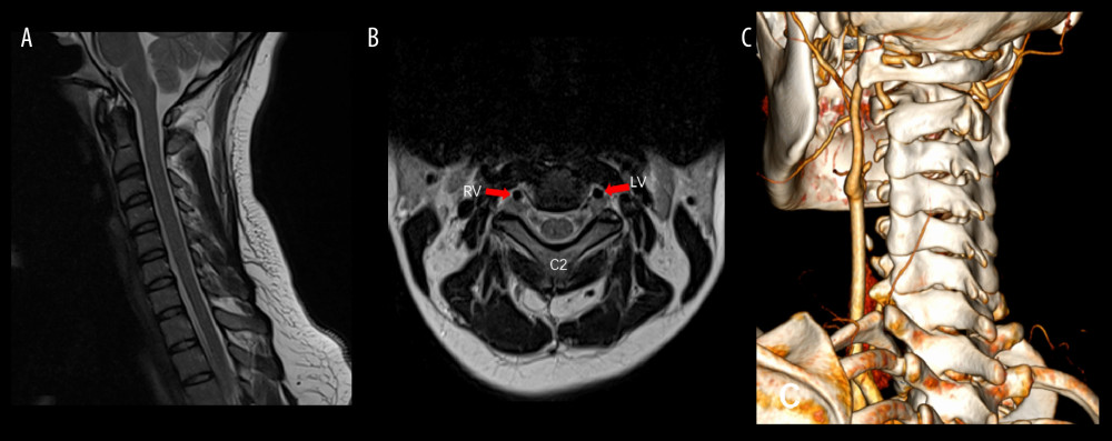 (A) Cervical spine MRI revealed a loss of the normal curvature of the spine, with a continuous sequence. (B) There were no signs of narrowing in the intervertebral spaces, and no noticeable bulging or protrusion of the intervertebral discs. There was no obvious abnormality in the adjacent structure of the vertebral artery. (C) Three-dimensional reconstruction of cervical spine CT showed no evidence of excessive bone growth in the cervical vertebrae or their attachments, and there was no narrowing of the bilateral intervertebral foramina. Additionally, there was no stenosis in the bony spinal canal, and no definite abnormal density shadow was observed in the spinal canal. MRI – magnetic resonance imaging; CT – computed tomography.