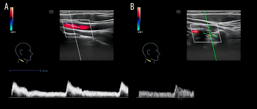 Color Doppler ultrasound indicates the following. (A) In the standard body position, the maximum flow velocity of the left vertebral artery was 44.6 cm/s. (B) With the head tilted to the right, the maximum flow velocity of the left vertebral artery was 18.2 cm/s.