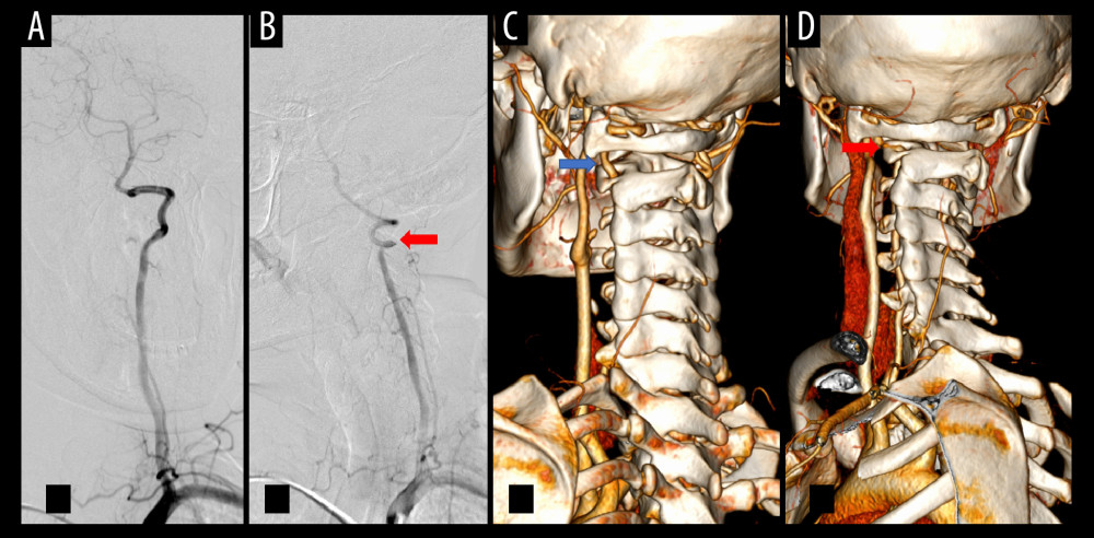(A) During angiography in the neutral head position, the left vertebral artery, basilar artery, and distal branches showed good contrast enhancement. (B) During angiography with the head tilted to the right, the left vertebral artery exhibits slow blood flow. A compressed indentation was observed in the V3 segment of the vertebral artery (indicated by the red arrow). The basilar artery and distal branches showed poor contrast enhancement. (C) In the neutral head position, CTA confirmed a normal anatomy and flow pattern of the left vertebral artery (indicated by the blue arrow). (D) CTA revealed that the left vertebral artery was compressed by the bone margin of the axis when the head was turned to the right (indicated by the red arrow). CTA – computed tomography angiography.