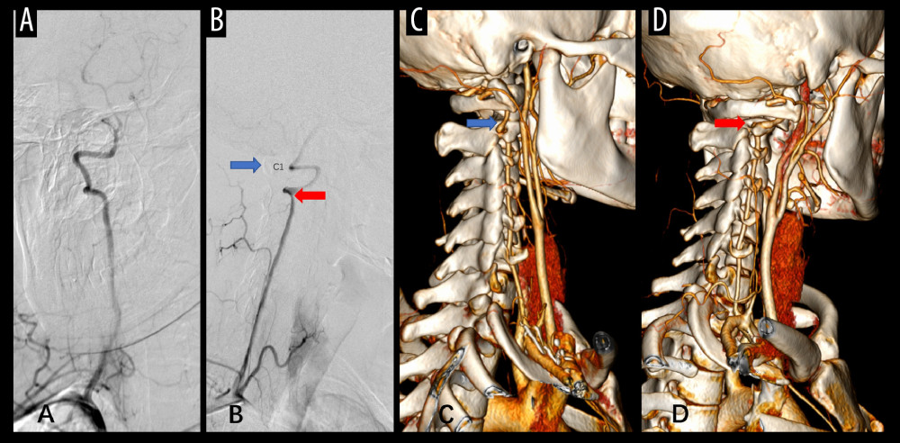 (A) During angiography in the neutral head position, the right vertebral artery, basilar artery, and distal branches showed good contrast enhancement. (B) During angiography with the head tilted to the left, the right vertebral artery exhibited decreased blood flow (red arrow indicates sign of compression), and the basilar artery and distal branches showed poor contrast enhancement (blue arrow indicates the contour of cervical C1). (C) In the neutral head position, CTA confirmed normal anatomy and flow pattern of the right vertebral artery (indicated by the blue arrow). (D) CTA revealed compression of the right vertebral artery by the bone margin of the axis when the head was turned to the left (indicated by the red arrow). CTA – computed tomography angiography.