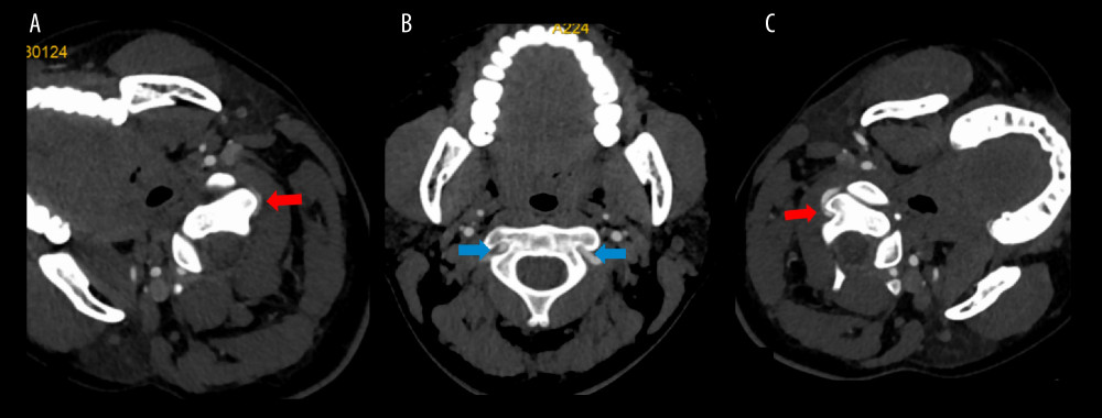 (A) When the head was deflected to the right, the left vertebral artery was narrowed by bony margin compression, as visualized on basal CT (indicated by red arrow). (B) When the head was in a neutral position, the bilateral vertebral arteries were clear, without compression (indicated by blue arrows). (C) When the head was deflected to the left, the right vertebral artery was visibly narrowed by bony margin compression on basal CT (indicated by red arrow). CT – computed tomography.