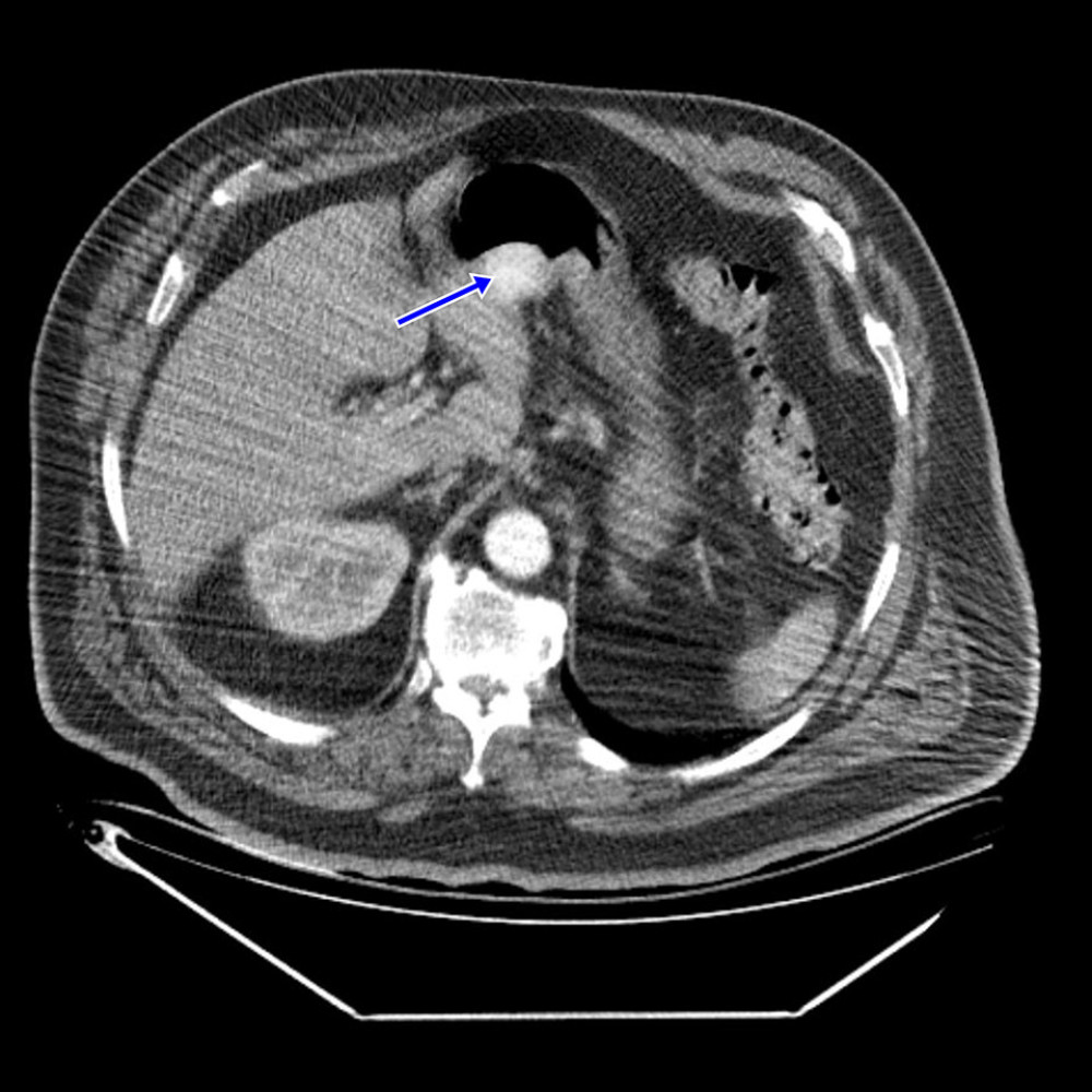 Nodular lesion with heterogeneous contrast uptake located at the level of the gastric antrum (arrow).