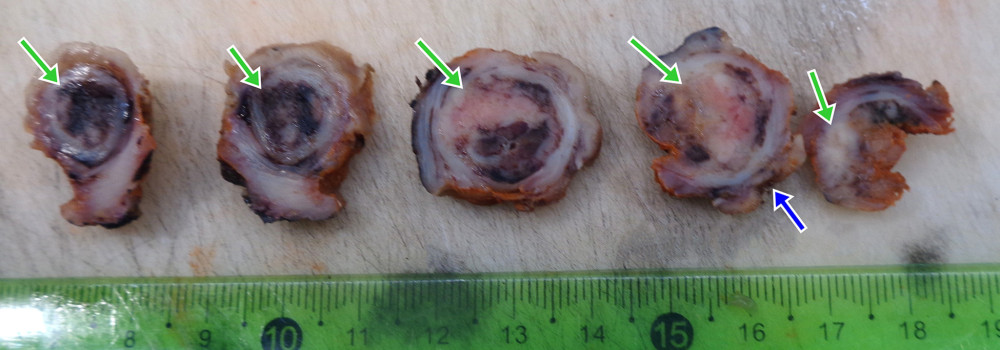 Macroscopic appearance of a nodular lesion in the gastric muscle (green arrow) that causes the elevation of the mucosa and its ulceration (blue arrow).