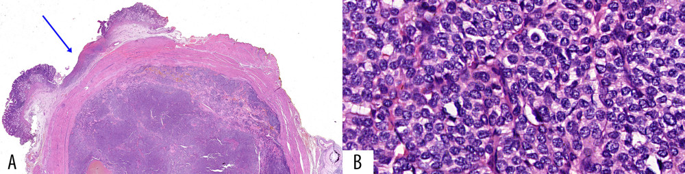 (A) Whole mount slide of wedge gastrectomy specimen showing glomus tumor located in the gastric wall causing mucosal ulceration (arrow) in hematoxylin-eosin staining. (B) Proliferating glomus cells with well-defined borders, weakly eosinophilic cytoplasm, central nuclei, rare distinct nucleoli, solid architecture, and fine branched vascular spaces (hematoxylin-eosin staining, ×600).