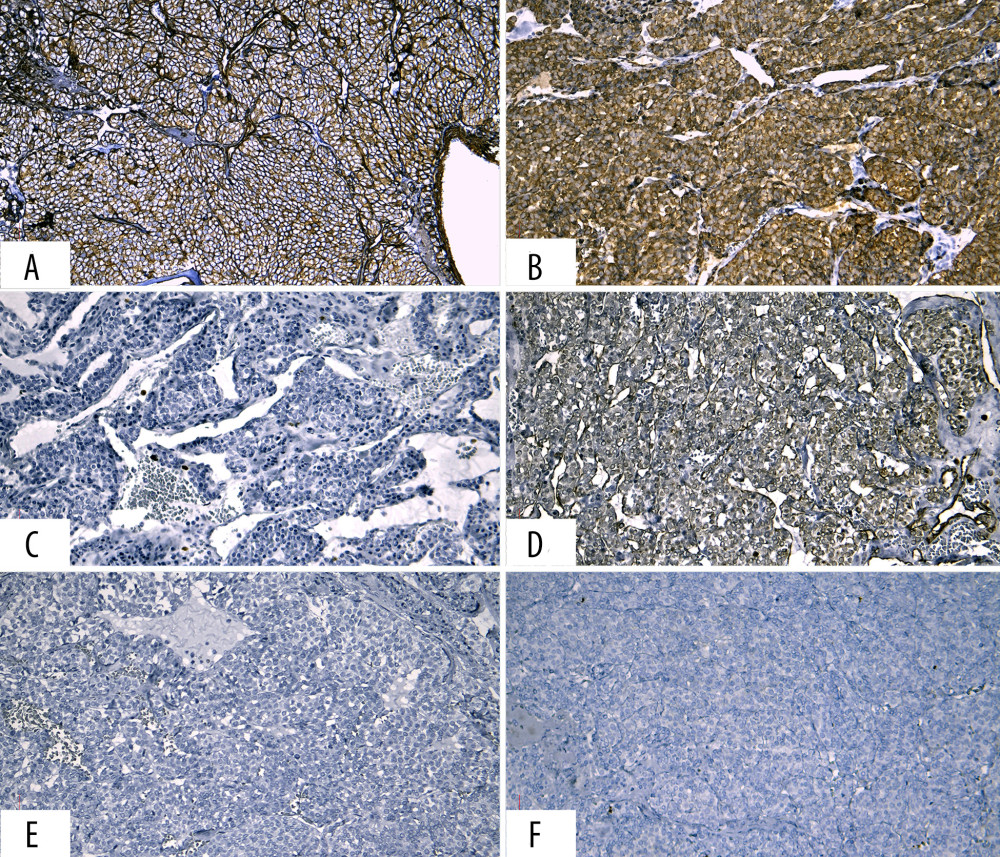 Immunohistochemical expressions in glomus tumor. (A) Strongly positive cytoplasmic and membrane collagen IV staining (×200). (B) Strongly positive cytoplasmic smooth muscle actin staining (×200). (C) Intensely positive nuclear Ki-67 staining about 1/50 high-power fields (×200). (D) Weakly positive cytoplasmic vimentin staining. (E) Negative chromogranin A staining (×200). (F) Negative DOG1 staining (×200).