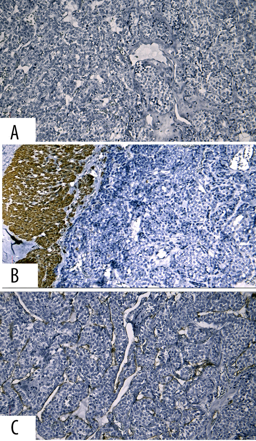 Immunohistochemical expressions in glomus tumor. (A) Negative HMB45 staining (×200). (B) Negative desmin staining, positive internal control (×200). (C) CD31 staining is negative in cells and positive in vessels (×200).