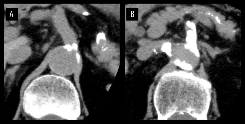 A plain computed tomography showing calcification at the origin of the celiac artery (A) and the superior mesenteric artery (B).