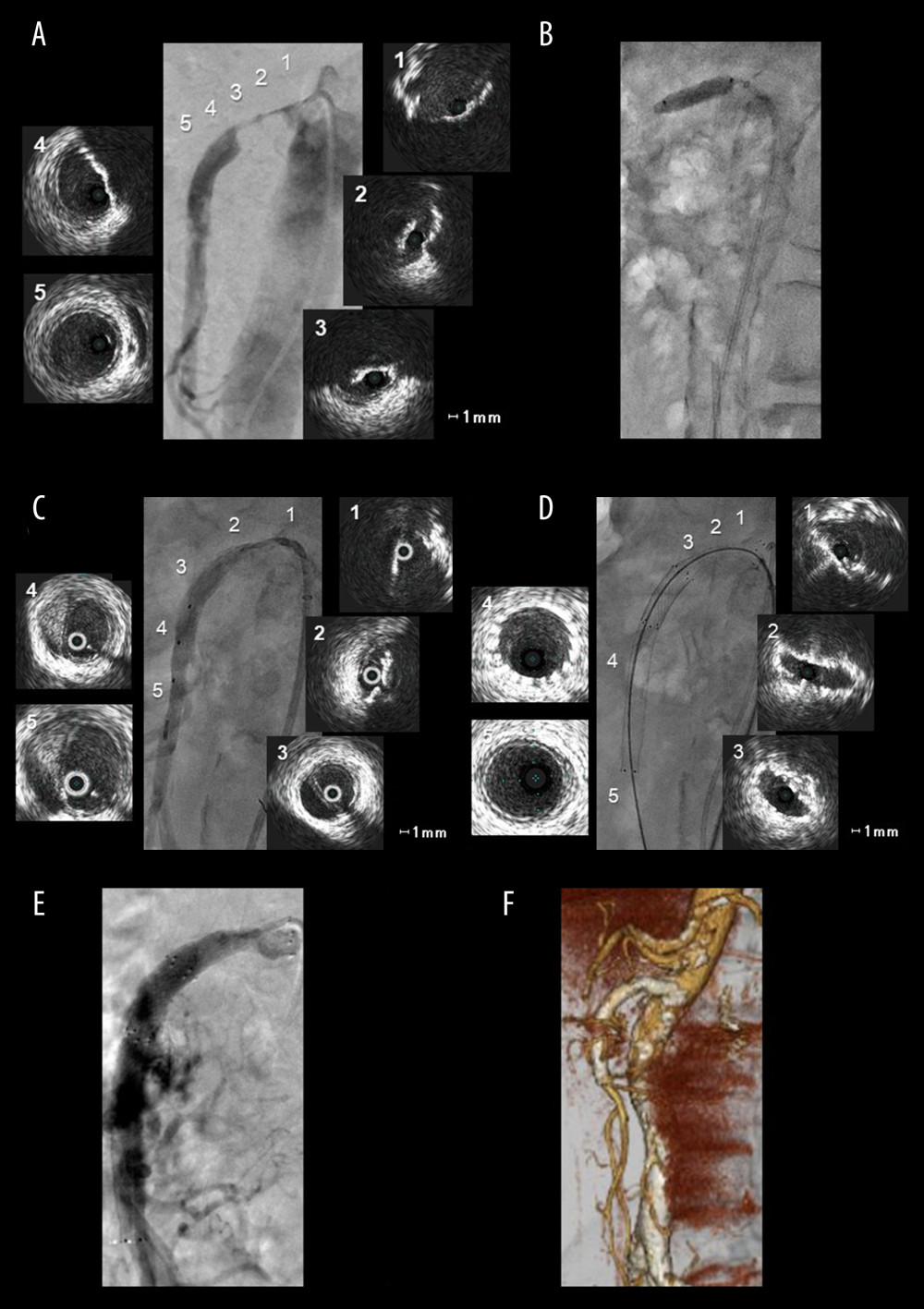 Pre-procedural angiography and intravascular ultrasound (IVUS) imaging of the superior mesenteric artery (SMA) (A). A cutting balloon was used to treat the stenosis of the SMA (B). Angiography after balloon angioplasty and intramural hematoma was observed with IVUS examination (C). Covering the whole dissection in the SMA with the implantation of self-expandable stents (D). Selective superior mesenteric angiography after endovascular therapy (E). The three-dimensional construction of computed tomography angiography after deployment of the self-expandable stents (F).