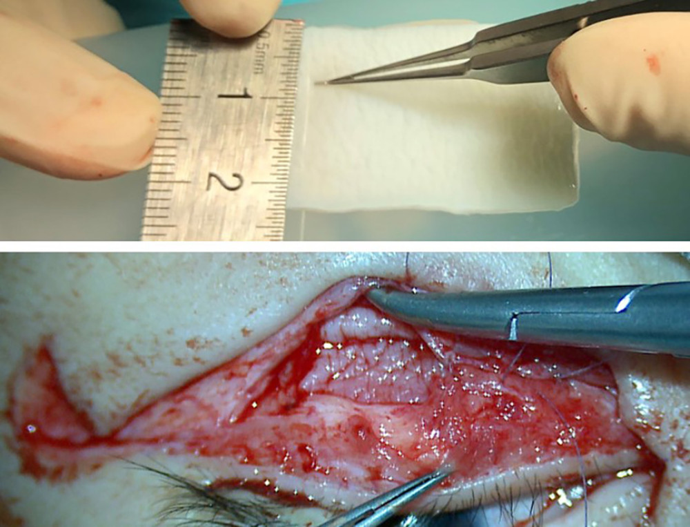 A trimmed acellular dermal allograft (12×4×0.6 mm) as a substitute for the tarsal plate was placed in the lower eyelid defect area and sutured with the free edge of the retractor.