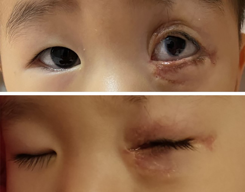 The lagophthalmos caused by the eyelid defect disappeared 1 month after surgery.