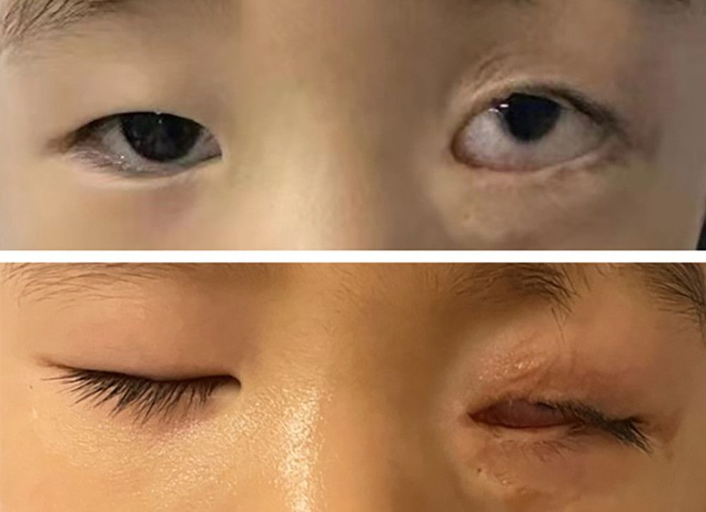 The lower eyelid showed significant retraction 18 months after surgery.