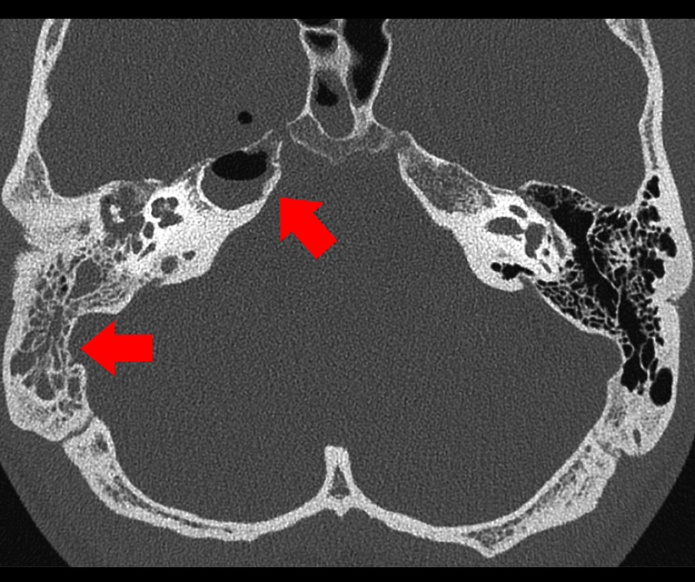 Axial computed tomography scan demonstrating otomastoiditis (lateral arrow) extending into the petrous apex where there is expansion with a gas and fluid collection (medial arrow).