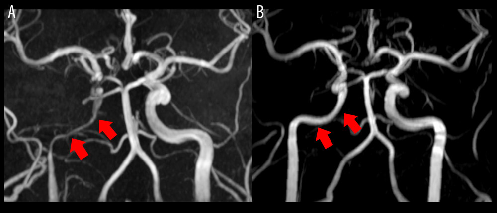 (A) Three-dimensional (3D) time-of-flight magnetic resonance angiography (MRA) demonstrating severe narrowing of the petrous and cavernous segments of the right internal carotid artery (ICA; 2 left-sided arrows). (B) 3D time-of-flight MRA 3 months after treatment demonstrating significantly improved caliber of the petrous and cavernous segments of the right ICA (2 left-sided arrows).