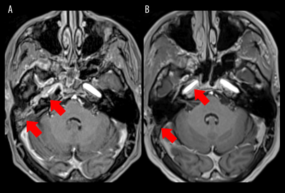 (A) Axial post-gadolinium T1-weighted magnetic resonance imaging (MRI) during hospital admission demonstrating right-sided otomastoiditis (lateral arrow) with petrous apicitis and minimal contrast enhancement of the ipsilateral petrous internal carotid artery (ICA; medial arrow). (B) Axial post-gadolinium T1-weighted MRI 3 months after treatment demonstrating resolution of otomastoiditis (lateral arrow) and significantly improved ipsilateral petrous ICA caliber (medial arrow).