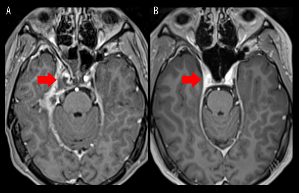 (A) Axial post-gadolinium T1-weighted magnetic resonance imaging (MRI) during hospital admission demonstrating right-sided cavernous sinus thrombosis with reduced ipsilateral cavernous internal carotid artery (ICA) caliber (left-sided arrow). (B) Axial post-gadolinium T1-weighted MRI 3 months after treatment showing resolution of cavernous sinus thrombosis with significantly improved ipsilateral cavernous ICA caliber (left-sided arrow).