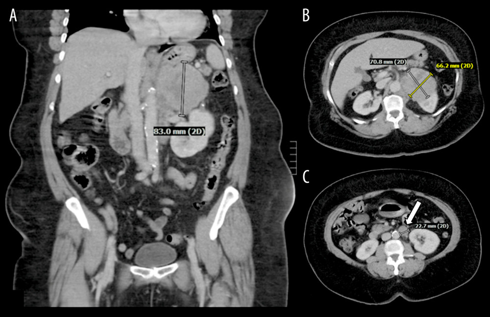 Case 1 computed tomography of the abdomen and pelvis without contrast. (A, B) A 7.1×6.6×8.3-cm heterogeneous mass in the left perirenal space. (C) An associated 2.2-cm left para-aortic lymph node (arrow).