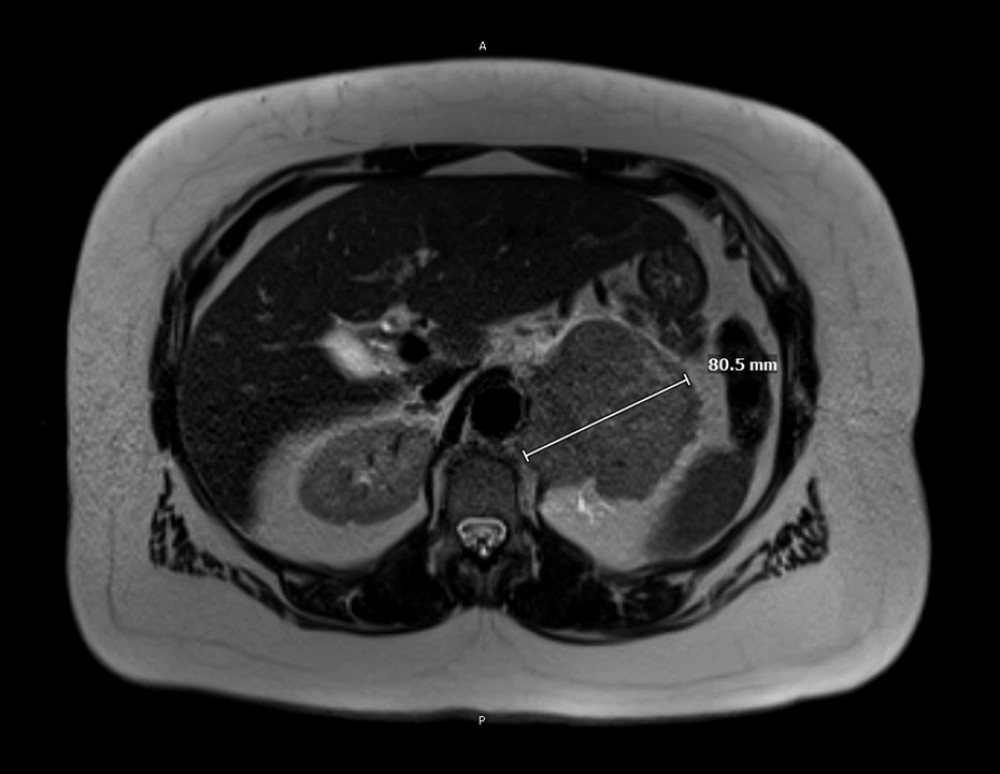 Case 1 magnetic resonance imaging of the abdomen and pelvis (axial). A large left retroperitoneal mass is visualized and favored to be of left adrenal origin.