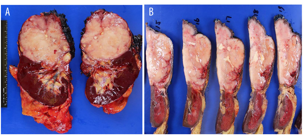 Case 1 gross photograph of resected retroperitoneal mass. (A) A large well-circumscribed mass with a “fish-flesh” cut surface (B) replaced the majority of the adrenal gland and portion of the kidney.