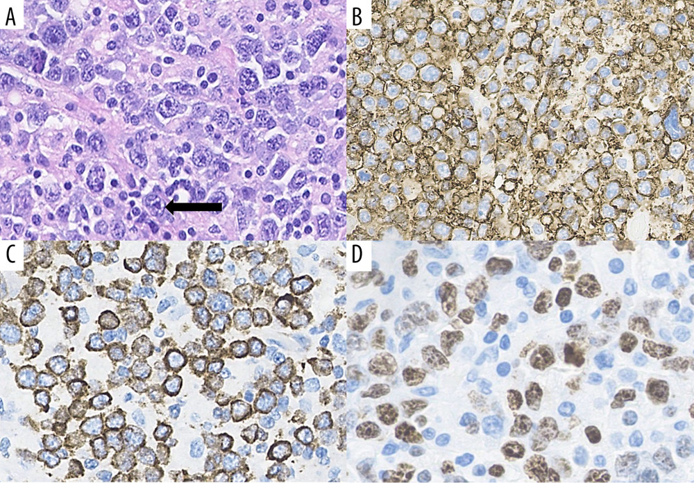 Case 1 histopathological features and immunohistochemical profile of resected retroperitoneal mass. (A) Sheets of large cells with vesicular nuclei and prominent nucleoli (arrow) (hematoxylin and eosin; 40×). Immunohistochemistry demonstrated atypical cells positive for (B) CD20 (40×) and (C) BCL-2 (40×). (D) The Ki-67 proliferation index is approximately 50% (40×).