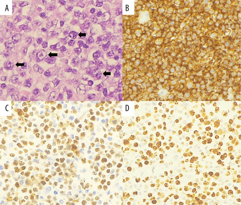 Case 2 histopathological features and immunohistochemical profile of resected thyroid specimen. (A) Diffuse infiltrate of intermediate to large cells with vesicular chromatin, prominent nucleoli and irregular nuclear contours (arrows) (hematoxylin and eosin; 40×). Immunohistochemistry demonstrated atypical cells positive for (B) CD20 (40×), (C) BCL-6 (>30%) (40×), with a (D) Ki-67 proliferation index of approximately 80% (40×).