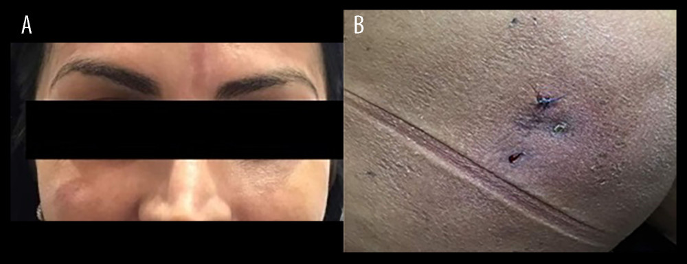 (A) Nodule resolution in the frontal and zygomatic areas with visible residual hyperpigmented area. (B) Plaque resolution in the buttocks, with scarring and residual hyperpigmentation in previously affected areas.