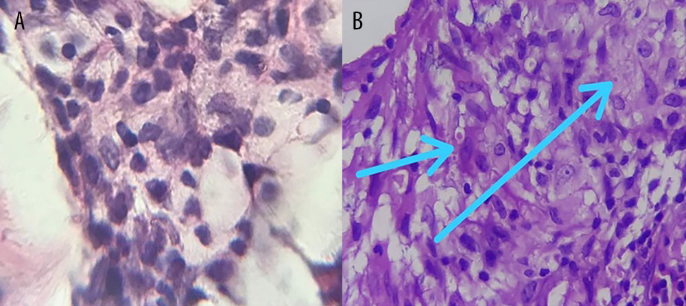 (A, B) In the dermis, hematoxylin and eosin (H&E) staining reveals dense infiltration of histiocytes, epitheloid cells and multinucleated Langhans giant cells. (B) Numerous intracellular yeast-like structures (blue arrows) with ovoid shape and a peripheral halo suggestive of Histoplasma capsulatum are visible.
