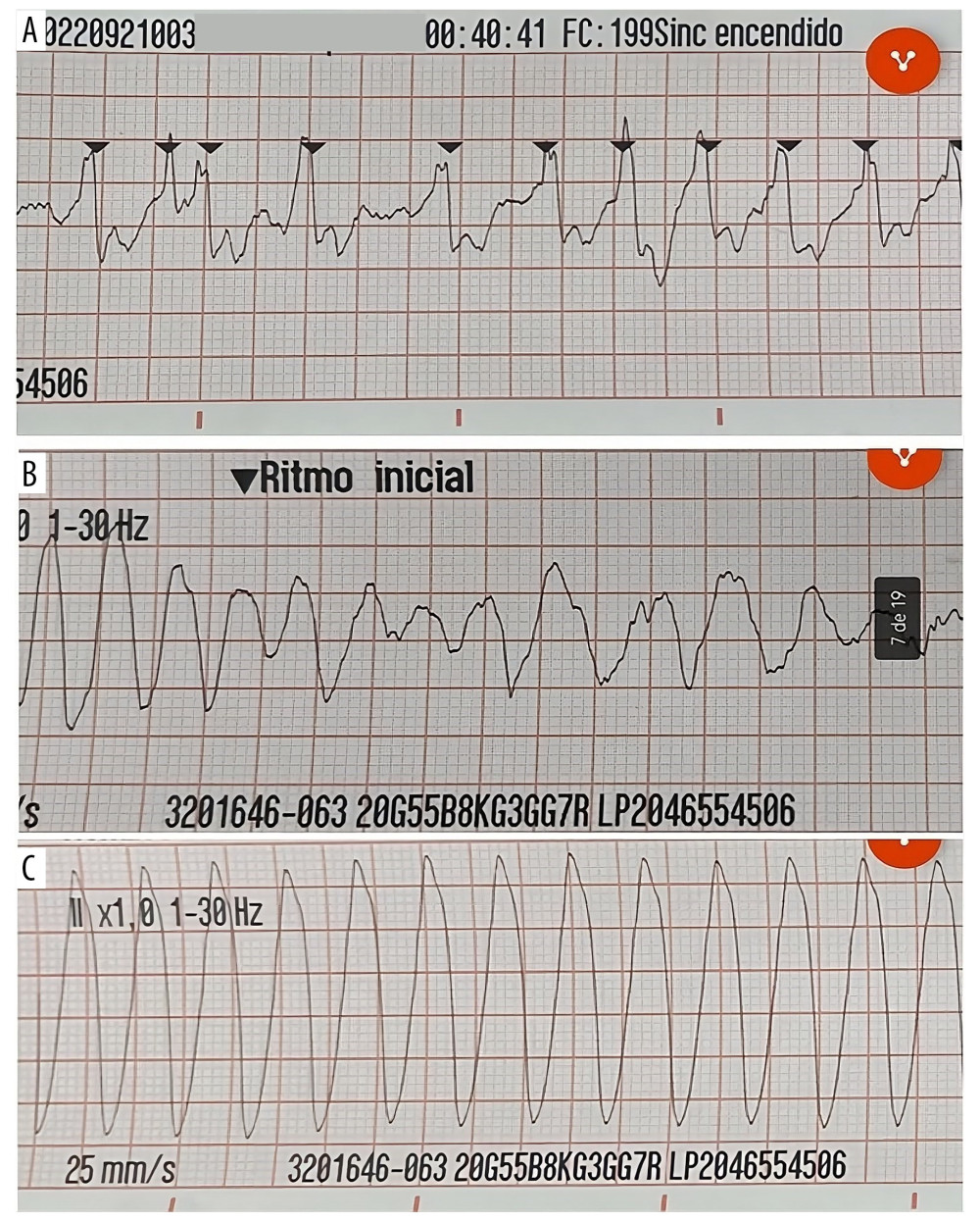 Electrocardiograms recorded during attention that show initial atrial fibrillation with rapid ventricular response and right bundle branch block (A), subsequent ventricular fibrillation rhythm (B) and, finally, sustained ventricular tachycardia (C).