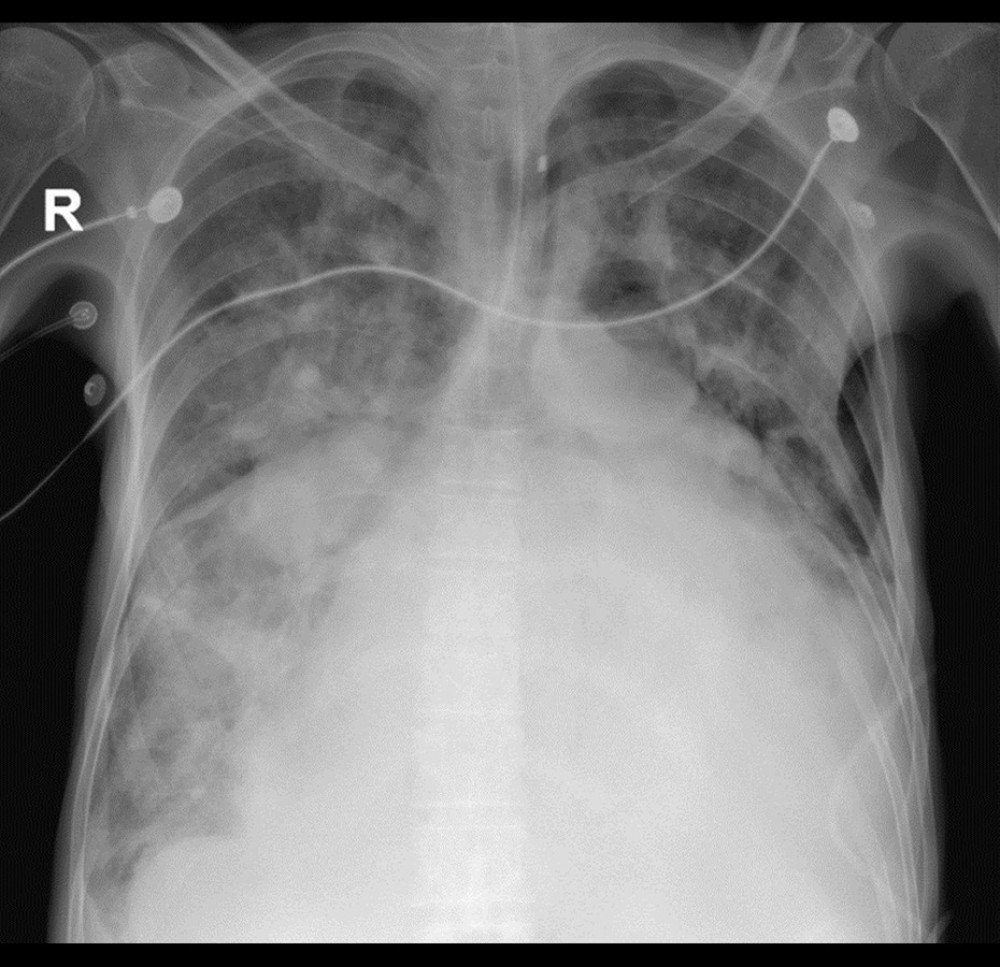 Chest X-ray showing severe cardiomegaly, generalized alveolar infiltrates, and possible left pleural effusion.