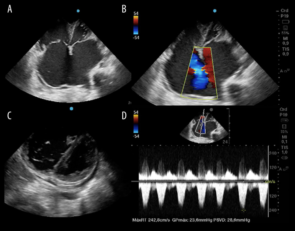 Bedside echocardiography showing the following: A and C present an apical 4-chamber and parasternal short-axis view, respectively, revealing significant dilatation of the right chambers. B: Color flow Doppler imaging showing a transatrial jet in an apical 4-chamber view, suggesting a large atrial septal defect. D: Continuous wave Doppler evaluation of tricuspid flow in the apical 4-chamber view, indicating tricuspid insufficiency.