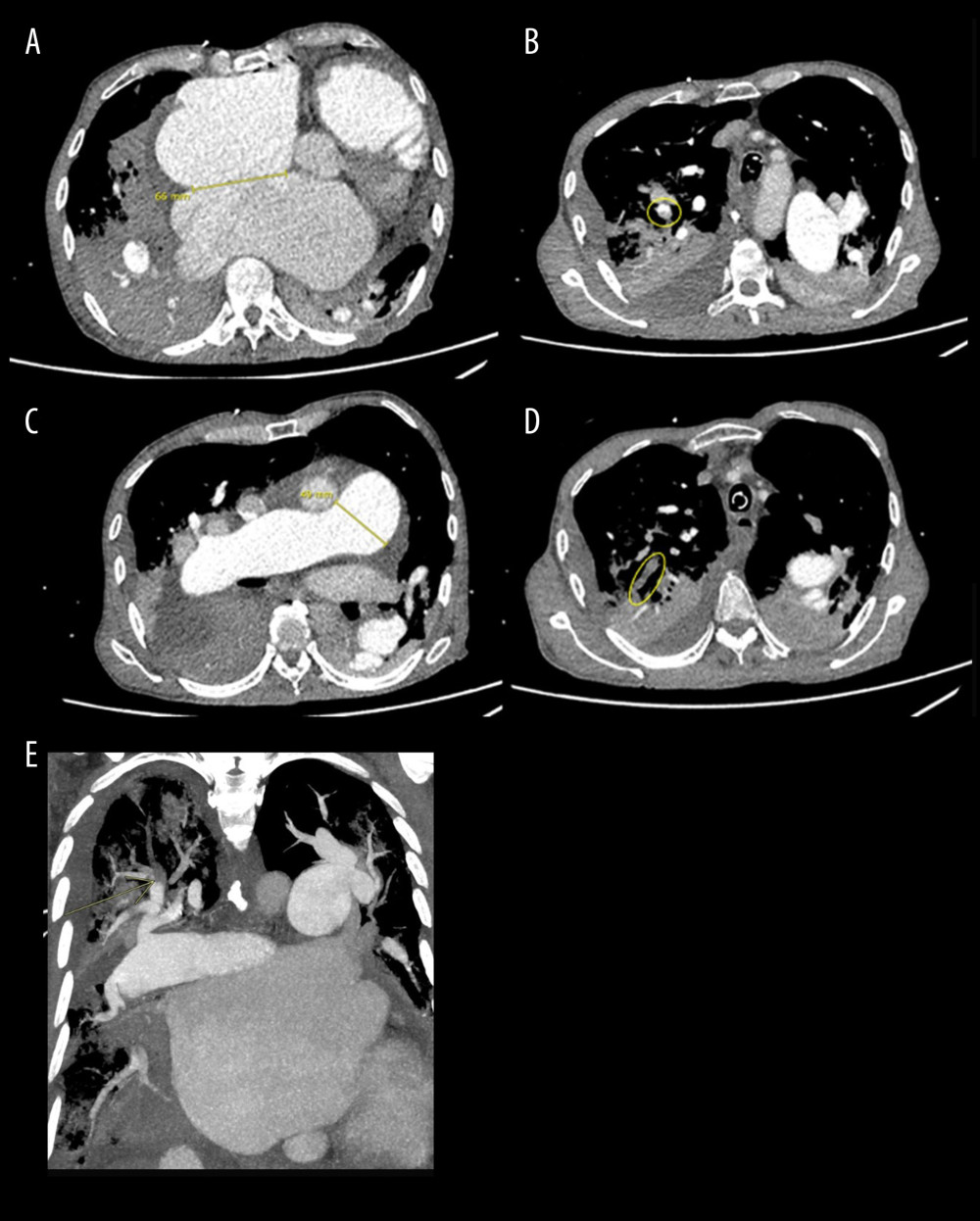 Chest CT angiography that confirms the presence of A: A large atrial septal defect (almost 7 cm), B: Acute (right upper lobe) and D: Chronic (left pulmonary artery and right lower lobe) pulmonary thromboembolism, associated with C: Dilation of the pulmonary artery (sign of pulmonary hypertension). E: Coronal projection with arrow marking a complete filling defect of the pulmonary artery for the posterior segment of the right upper lobe.