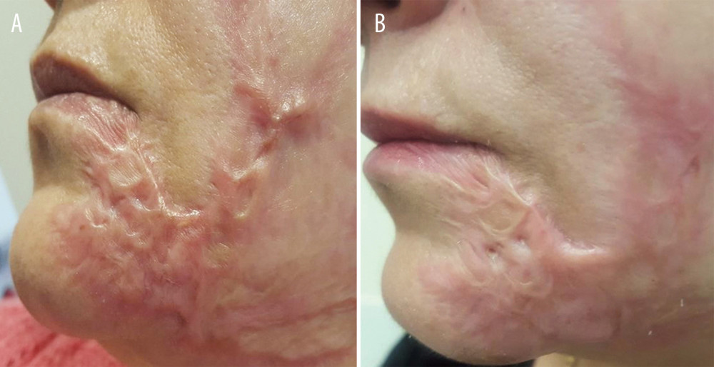A woman with a traumatic hypertrophic scar on the left side of the face with uneven edges, before (A) and after 1 laser therapy session. (B) A noticeable improvement in skin texture and color, associated with a partial regression of the hypertrophic scar, was observed.