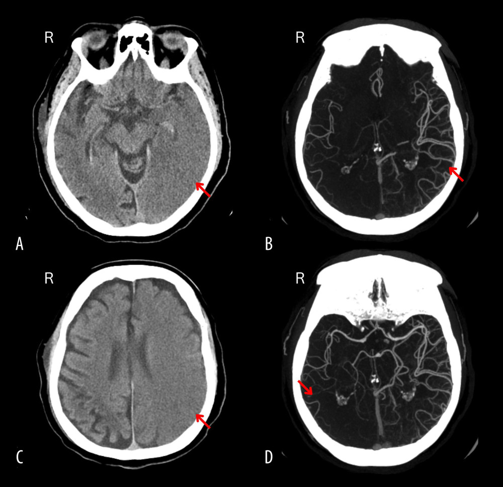 (A, B) Axial computed tomography brain scan showing mild hypodense acute ischemia zone throughout the left cerebral hemisphere, except the basal nuclei. (C, D) Angiography maximum intensity projection revealing more pronounced vasodilated cortical branches in the left middle cerebral artery than the right side with no conclusive data for lumen narrowing, double lumen fillings or pathological expansions.