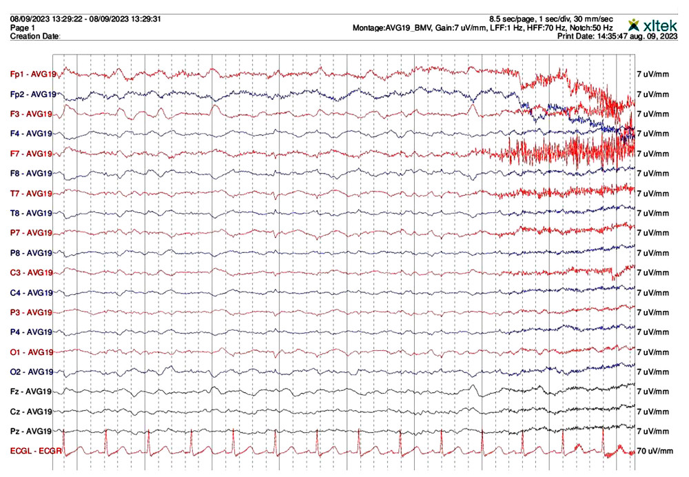 Day 4 electroencephalogram recording a disorganized diffuse background slowing in the theta spectrum. The forehead region of the left hemisphere showing epileptiform activity.