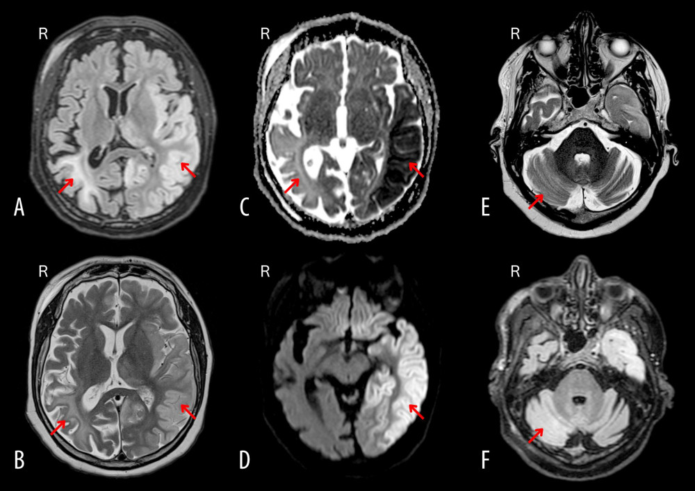 First axial magnetic resonance image. (A) FLAIR-weighted and (B) T2-weighted showing vasogenic edema throughout the left cerebral hemisphere including the temporal, occipital lobes, thalamus and hippocampus. On the right side an older deep periictal lesion with atrophy from a previous seizure. (C) Diffusion-weighted apparent diffusion coefficient (ADC) and (D) diffusion weighted imaging (DWI) showing a decrease in ADC value and increased DWI signal throughout the left cerebral hemisphere and a slightly increased ADC value in the right cerebral hemisphere. As well as (E) T2-weighted and (F) FLAIR-weighted of cerebellum showing a small area of vasogenic edema in the right cerebellum, cortically affecting the amygdala as well, on the opposite side of the cerebral lesion – a crossed cerebellar diaschisis.