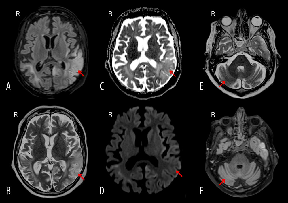 Second axial MRI (A) FLAIR-weighted and (B) T2-weighted showing a partially reversible post-ictal lesion on the left cerebral hemisphere with decreased size and intensity in comparison with the previous MRI. (C) Diffusion-weighted apparent diffusion coefficient (ADC) and (D) diffusion weighted imaging (DWI) revealing increase in ADC values and mimicking the intensity of the previous lesion on the right side and the (E) T2-weighted and (F) FLAIR-weighted of cerebellum with no longer visible right cerebellar lesion.