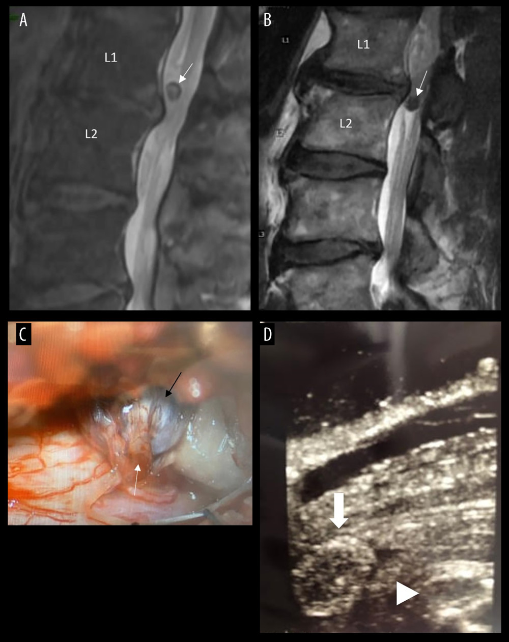 (A) Non-contrast magnetic resonance imaging (MRI) of the lumbar spine reveals a well-defined mass (white arrow) just superior to the L1–2 bulged disc. (B) MRI with contrast shows the tumor (white arrow) has migrated caudally to the inferior border of the L1–2 bulged disc. (C) Intraoperative photograph shows the tumor (black arrow) originated from a nerve root (white arrow). (D) Intraoperative (post-laminectomy) ultrasonography demonstrates the tumor (white arrow) and the bulged disc (arrowhead).